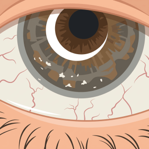 Dry Eyes